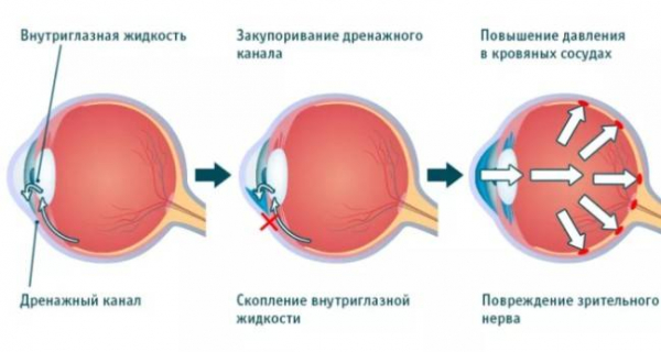 Как глаукома влияет на ваше зрение