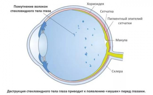 Вспышки и мушки в глазах, когда обратиться к врачу