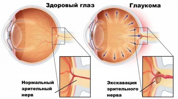 Как глаукома влияет на ваше зрение