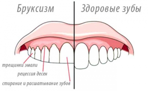 Что такое бруксизм