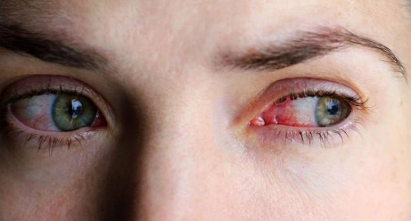6 возможных причин красных глаз