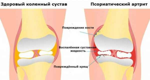 Как предотвратить обострение псориатического артрита