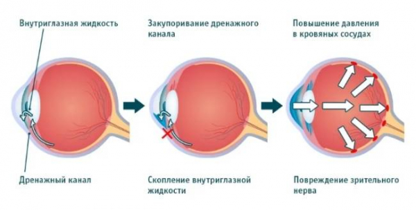 Симптомы глаукомы, которые необходимо знать