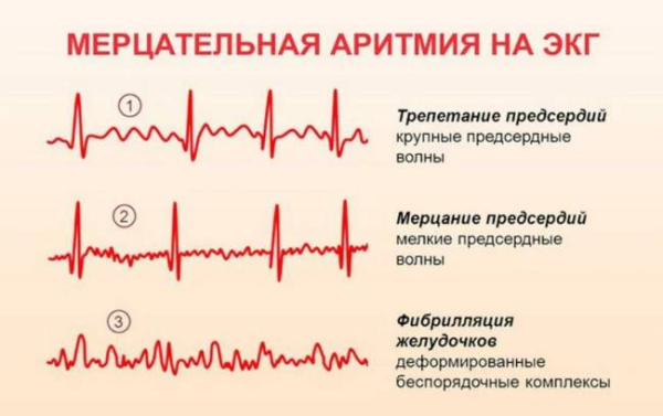 Что заставляет сердце пропускать удары