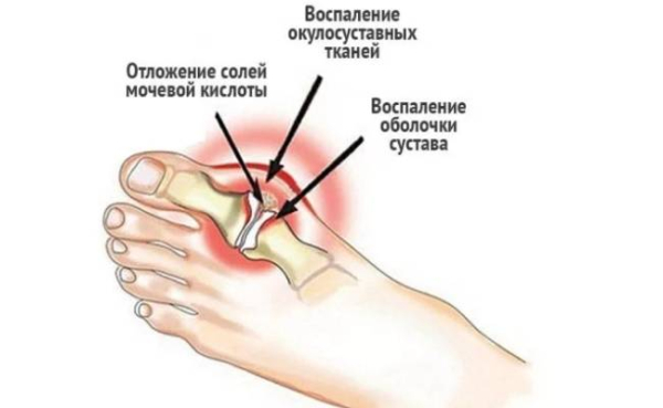 Можно ли предотвратить подагру