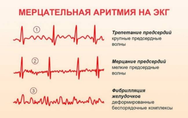 Изменение образа жизни при мерцательной аритмии