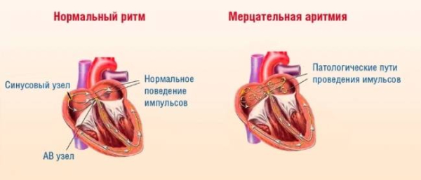 Изменение образа жизни при мерцательной аритмии