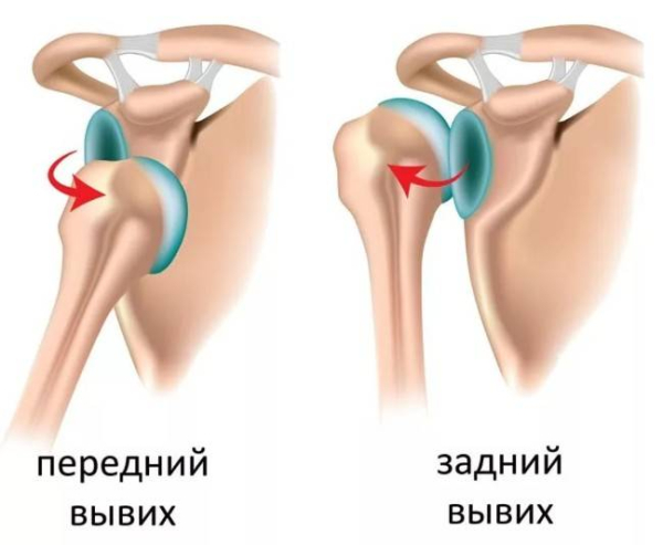 Симптомы и лечение вывиха плеча