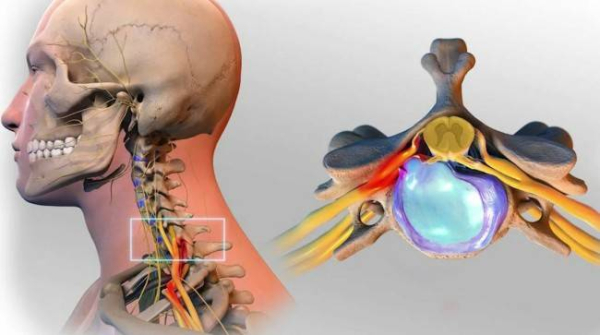 Причины, симптомы и лечение шейной грыжи
