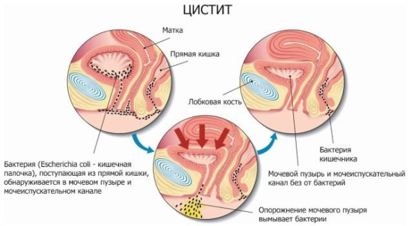 10 рекомендаций по профилактике цистита