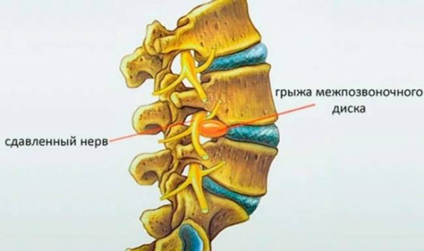 Что такое грыжа межпозвоночного диска