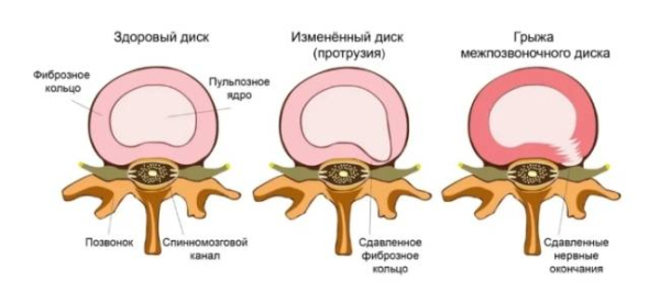 Что такое грыжа межпозвоночного диска