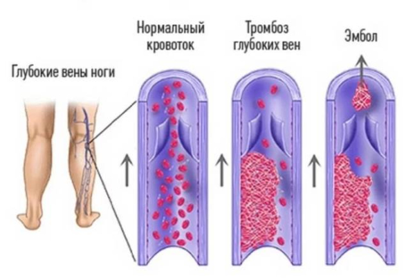 Распознавание симптомов образования тромбов