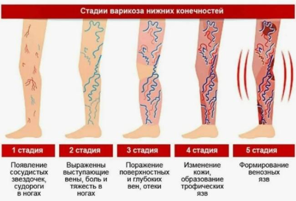 Почему лечение варикозного расширения вен не следует откладывать