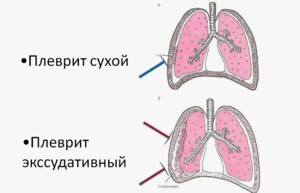 Что такое плеврит