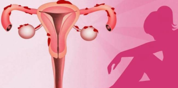 4 незаметных симптома эндометриоза, которые вы должны знать