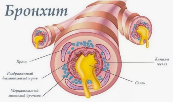Острый бронхит